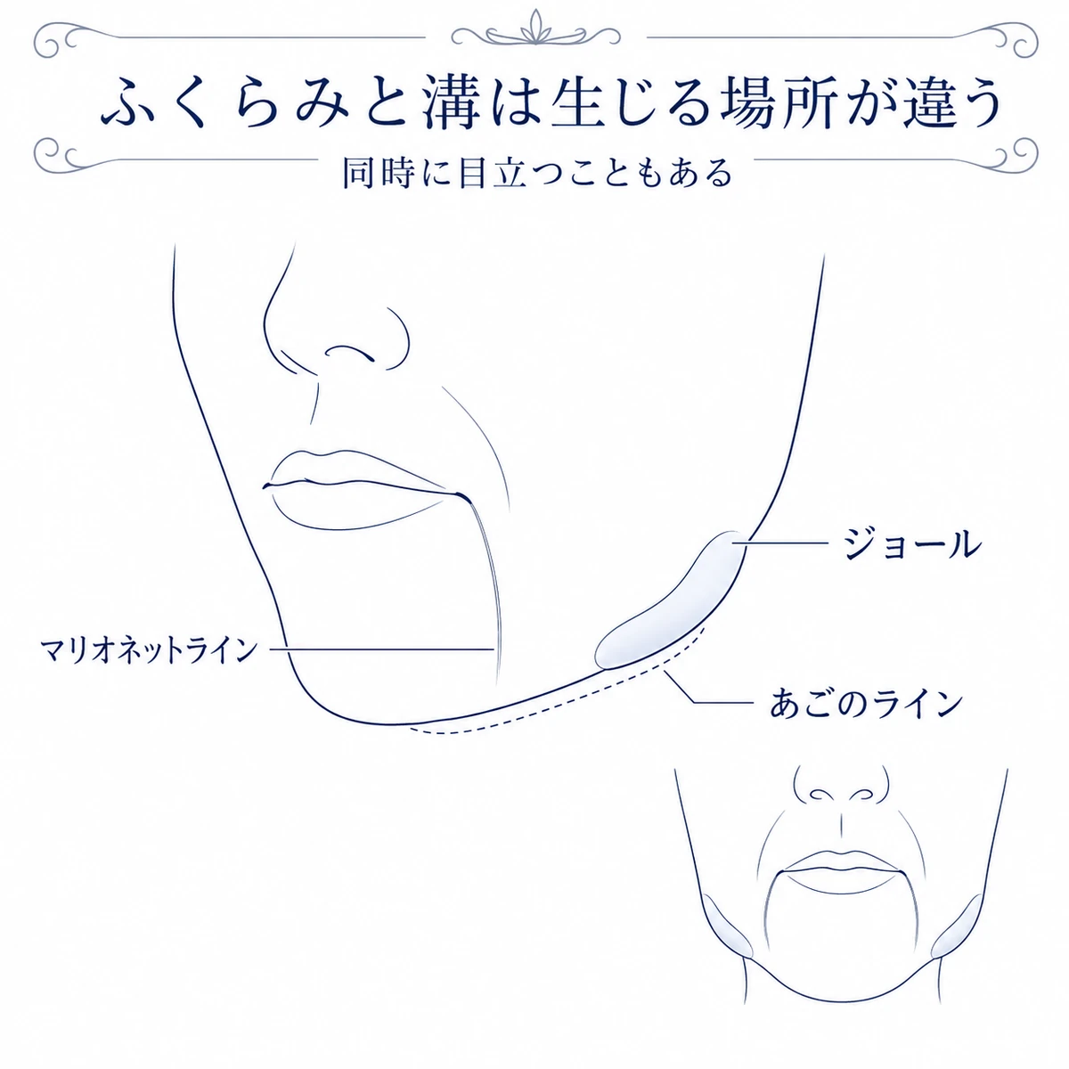 斜め向きの口元で、あごの輪郭に接するジョールのふくらみと口角から下へ延びる溝の位置を描き分けた図