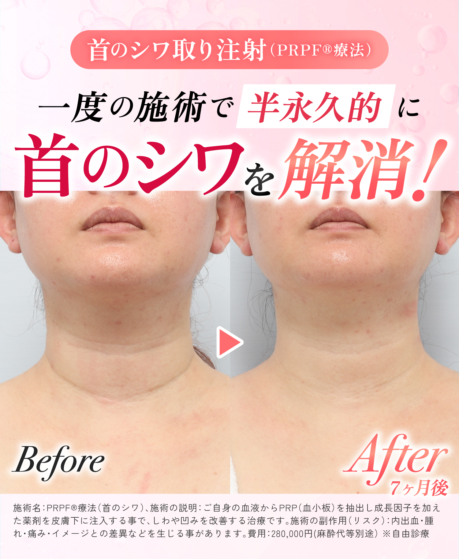 首のシワ取り注射