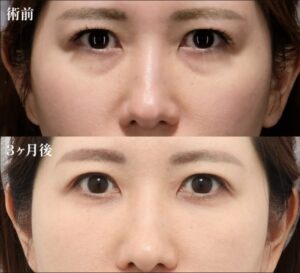 裏ミッドフェイスリフト