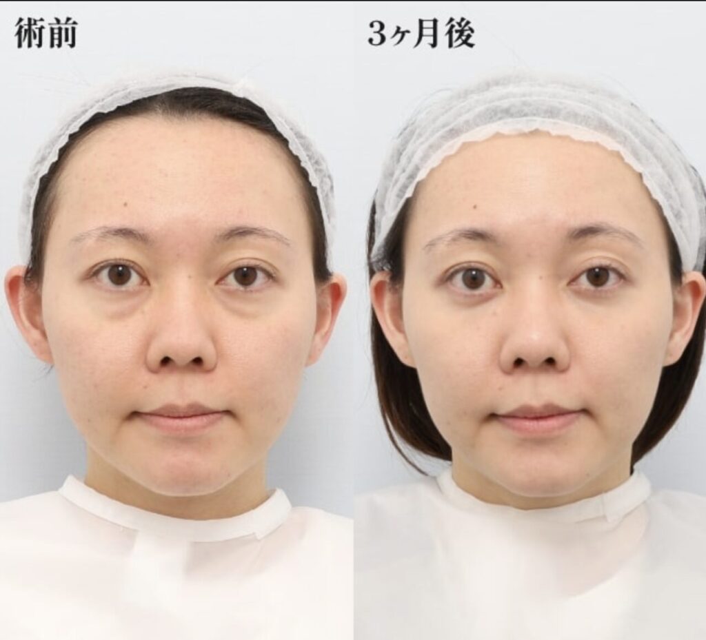 裏ミッドフェイスリフト