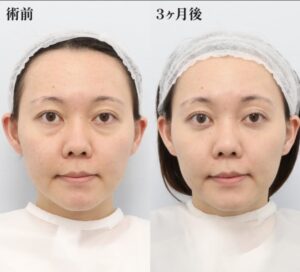 裏ミッドフェイスリフト