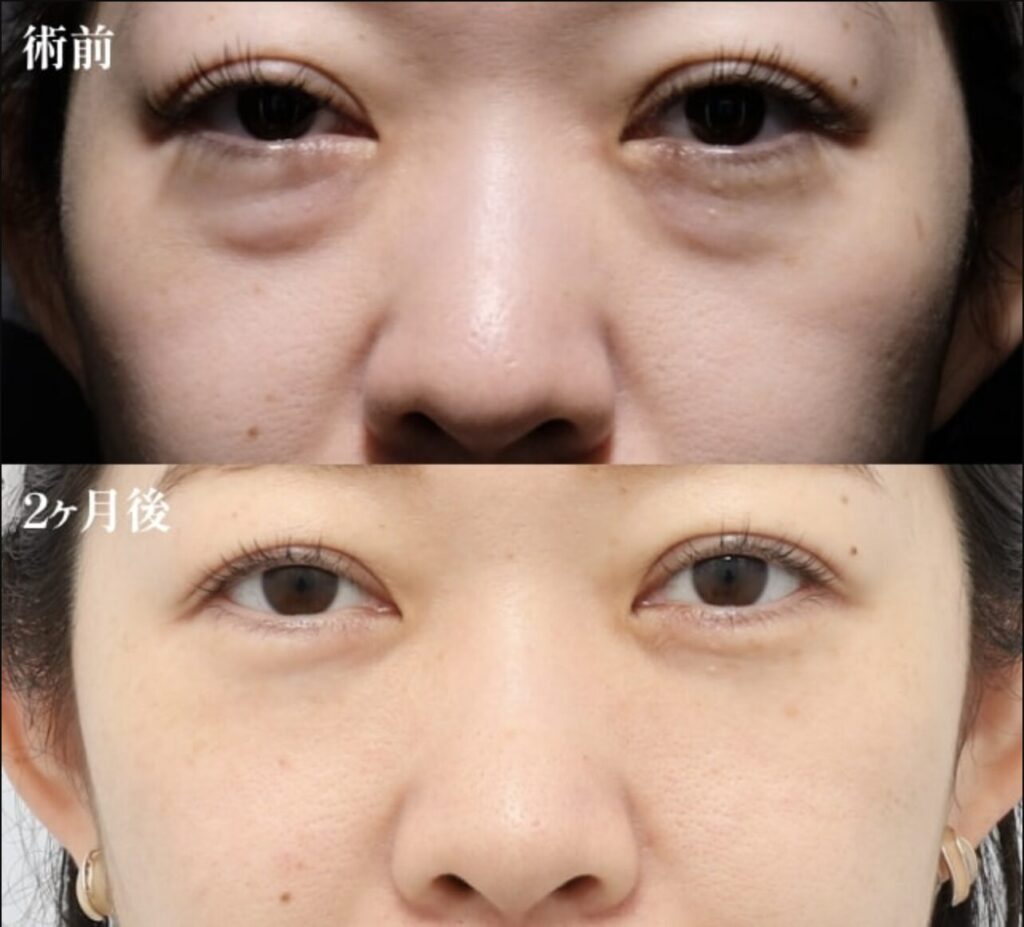 PRPF療法（目の下、ゴルゴライン）