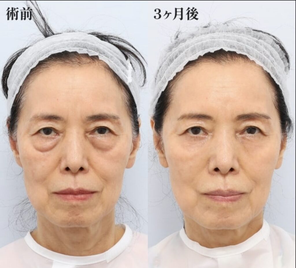 裏ミッドフェイスリフトPRPF療法（目の下、法令線）