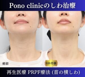 PRPF療法首の横シワ改善の症例、上