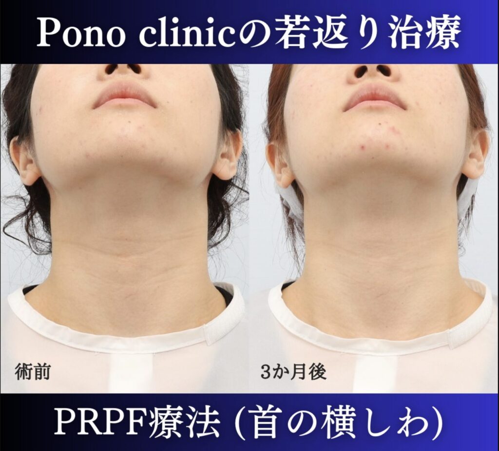 首のしわ治療のPRPF療法の症例、アップ