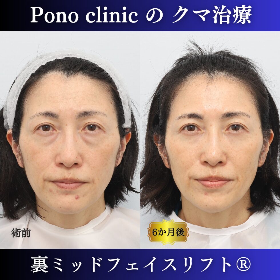 目の下のクマ、目の下のたるみ、影クマ、裏ミッドフェイスリフト®、50代の症例 (7)