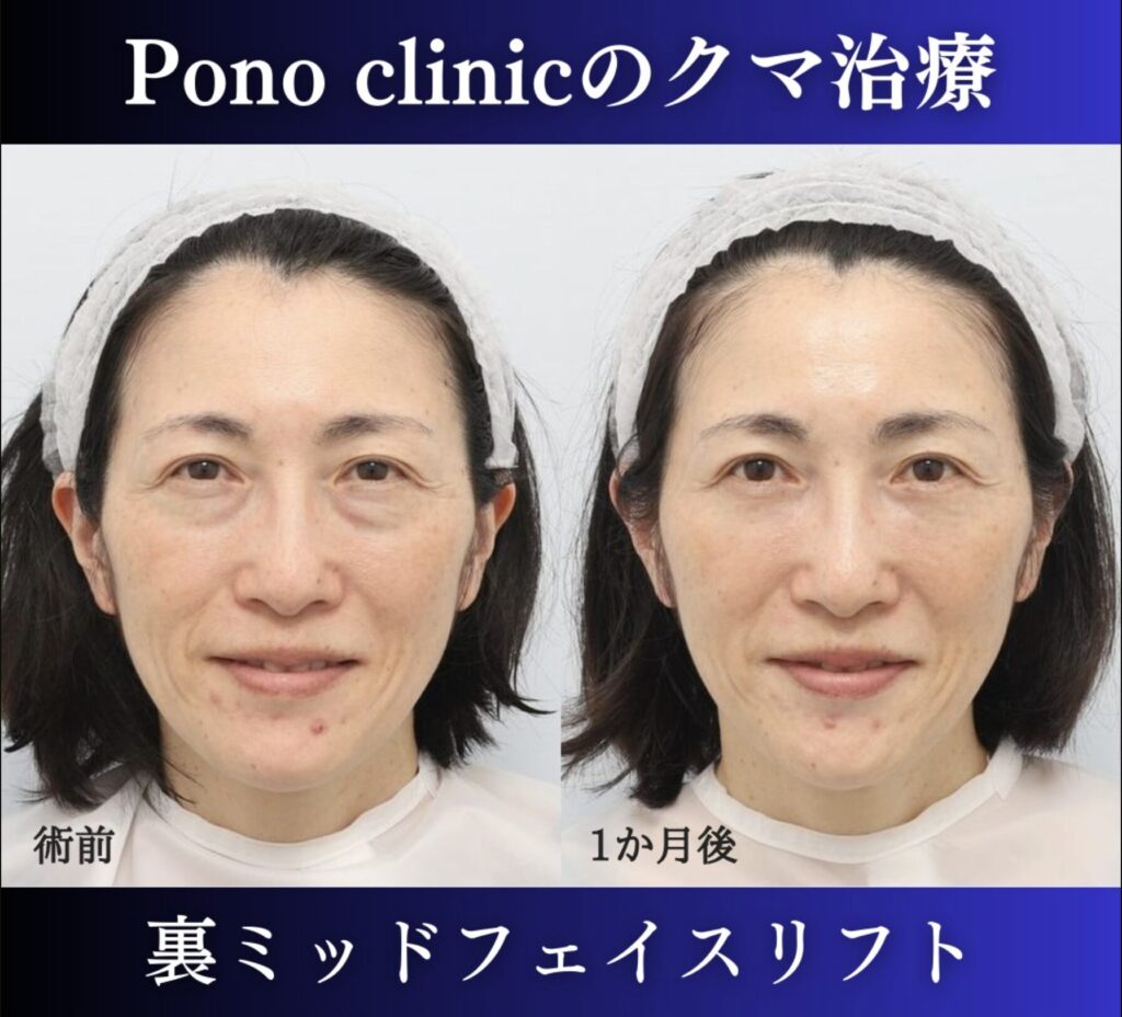 裏ハムラ、ミッドフェイスリフトの症例、術後1か月笑顔