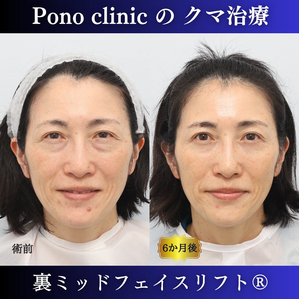 目の下のクマ、目の下のたるみ、影クマ、裏ミッドフェイスリフト®、50代の症例 (4)