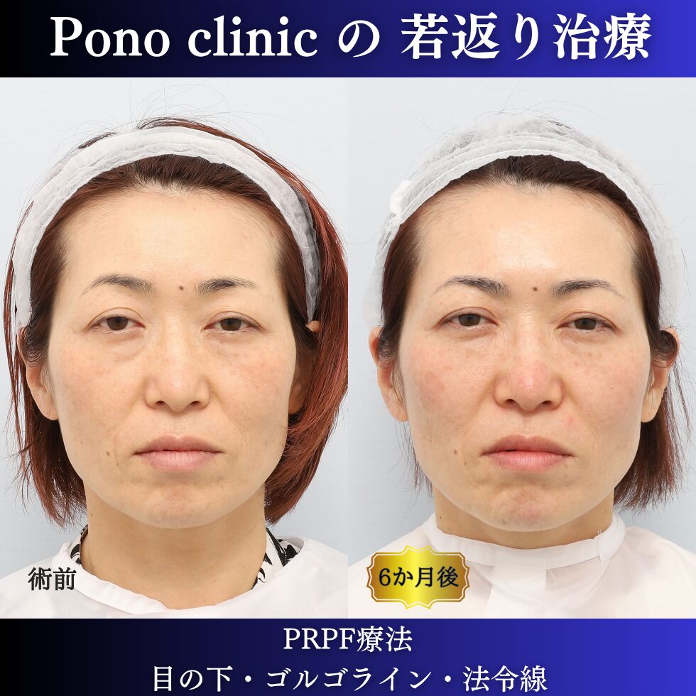 PRPF療法、目の下のクマ、ゴルゴライン、法令線、40代の症例