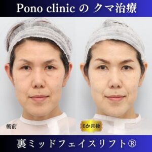 裏ミッドフェイスリフト®、50代の症例