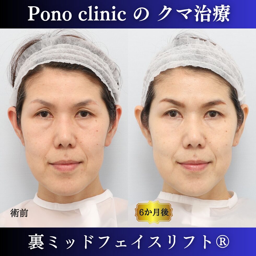 裏ミッドフェイスリフト®、50代の症例