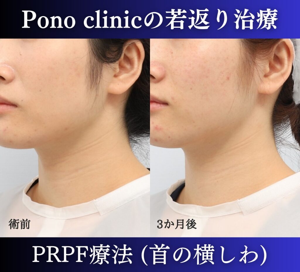 首のしわ治療のPRPF療法の症例、横