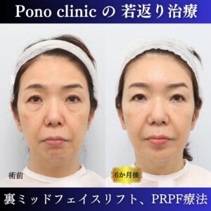 裏ミッドフェイスリフト®、PRPF療法、50代の症例