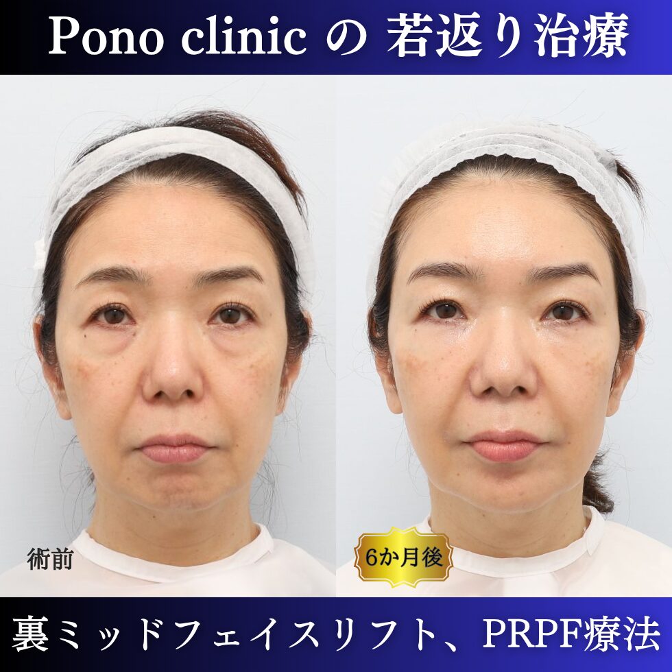 裏ミッドフェイスリフト®、PRPF療法、50代の症例