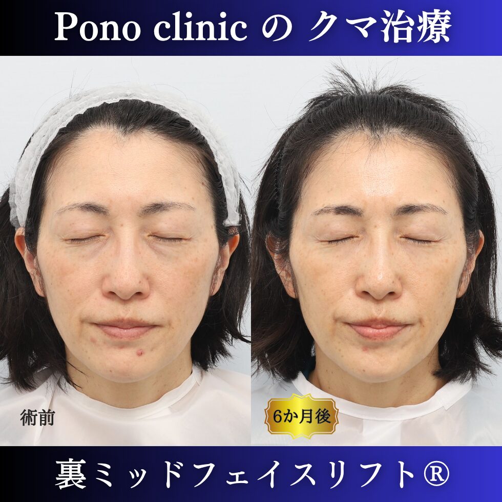 目の下のクマ、目の下のたるみ、影クマ、裏ミッドフェイスリフト®、50代の症例 (6)