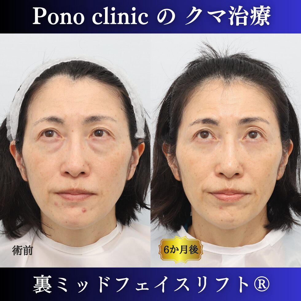 目の下のクマ、目の下のたるみ、影クマ、裏ミッドフェイスリフト®、50代の症例 (5)