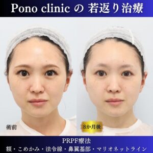 PRPF療法、法令線治療、30代の症例