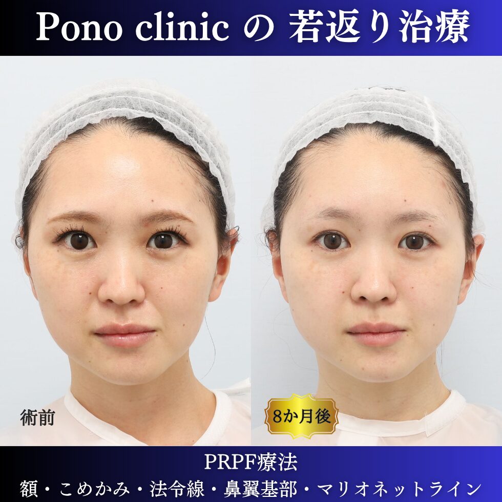 PRPF療法、法令線治療、30代の症例