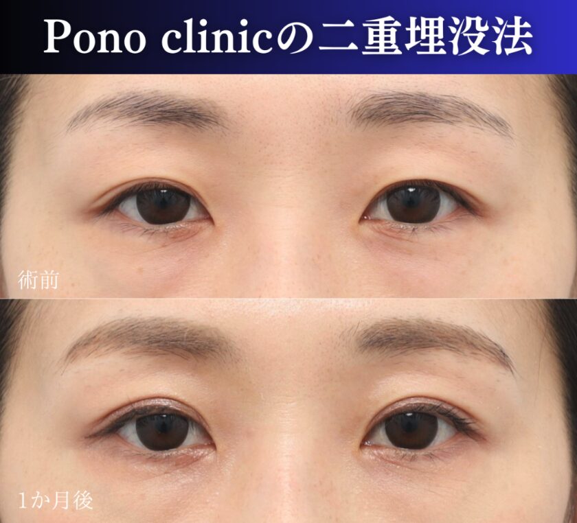 二重埋没2ループ症例