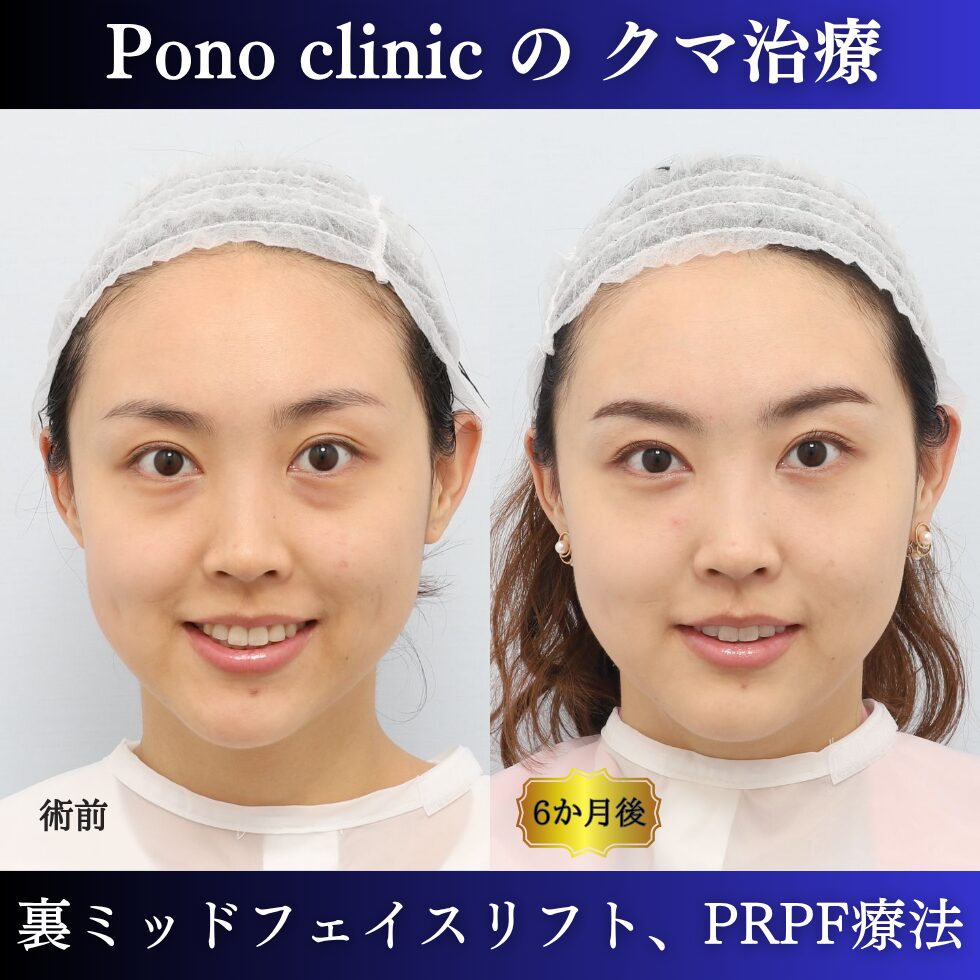 裏ミッドフェイスリフト®、PRPF療法目の下、20代の症例