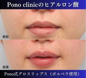 唇ヒアルロン酸注入の症例、直後 (3)