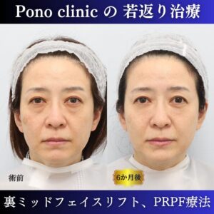 目の下のクマ、目の下のたるみ、黒クマ影クマ、裏ミッドフェイスリフト®、PRPF療法、50代の症例