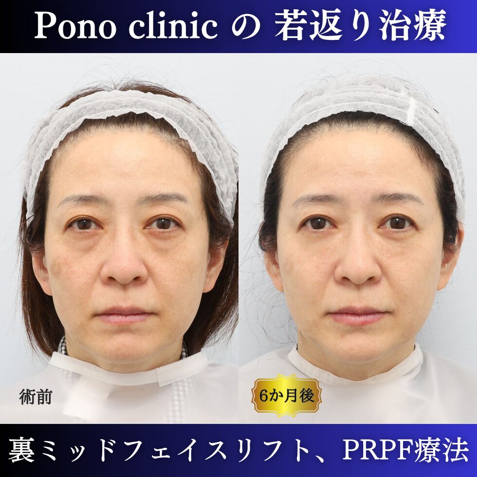 目の下のクマ、目の下のたるみ、黒クマ影クマ、裏ミッドフェイスリフト®、PRPF療法、50代の症例