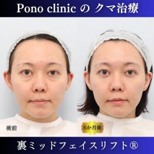目の下のクマ、目の下のたるみ、影クマ、20代の症例