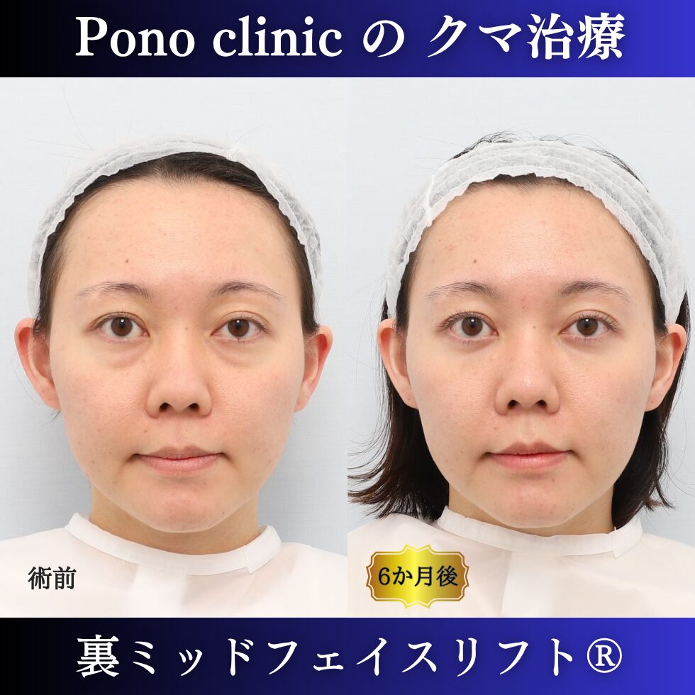 目の下のクマ、目の下のたるみ、影クマ、20代の症例