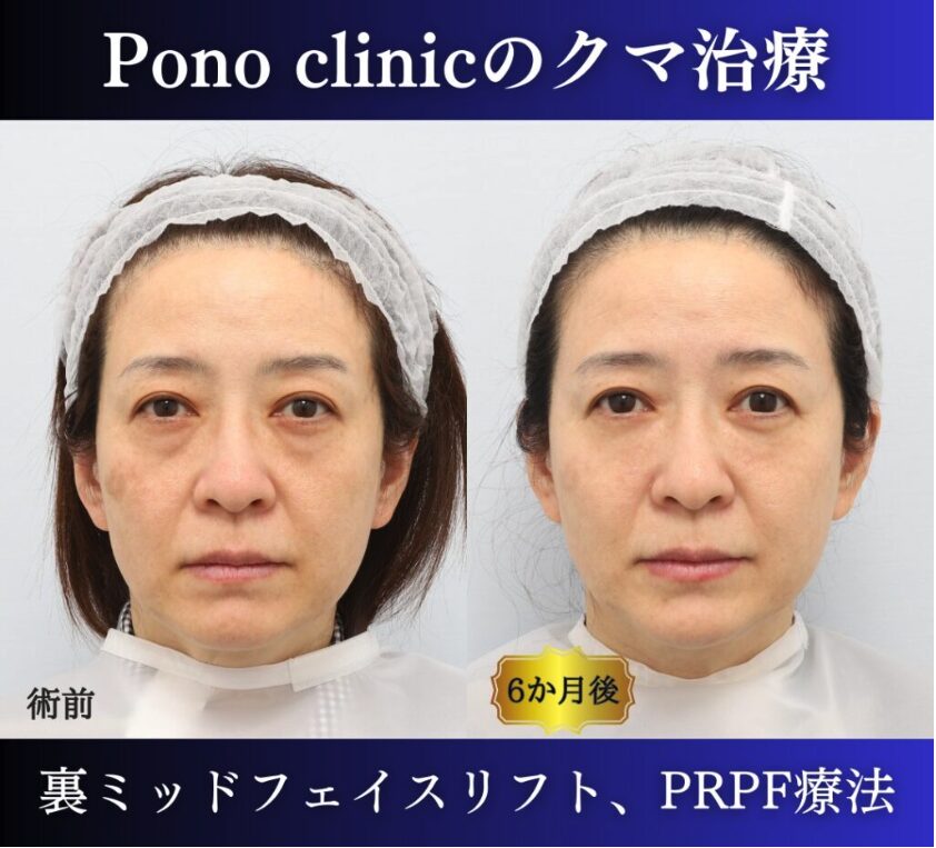 クマ取り東京、裏ハムラ・ミッドフェイスリフト、PRPF療法目の下の症例、正面