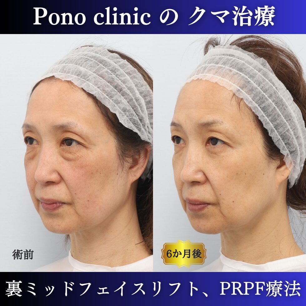 目の下のクマ、目の上のくぼみ、裏ミッドフェイスリフト、PRPF療法、50代の症例 (3)