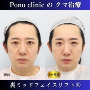クマ治療、裏ミッドフェイスリフト、裏ハムラ法、骨膜下リフト、40代の症例