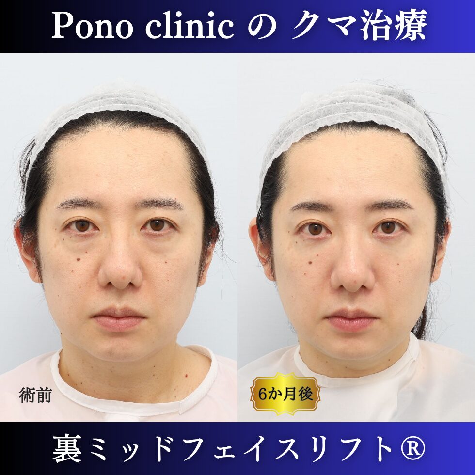 クマ治療、裏ミッドフェイスリフト、裏ハムラ法、骨膜下リフト、40代の症例