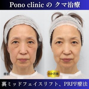 目の下のクマ、目の上のくぼみ、裏ミッドフェイスリフト、PRPF療法、50代の症例 (7)