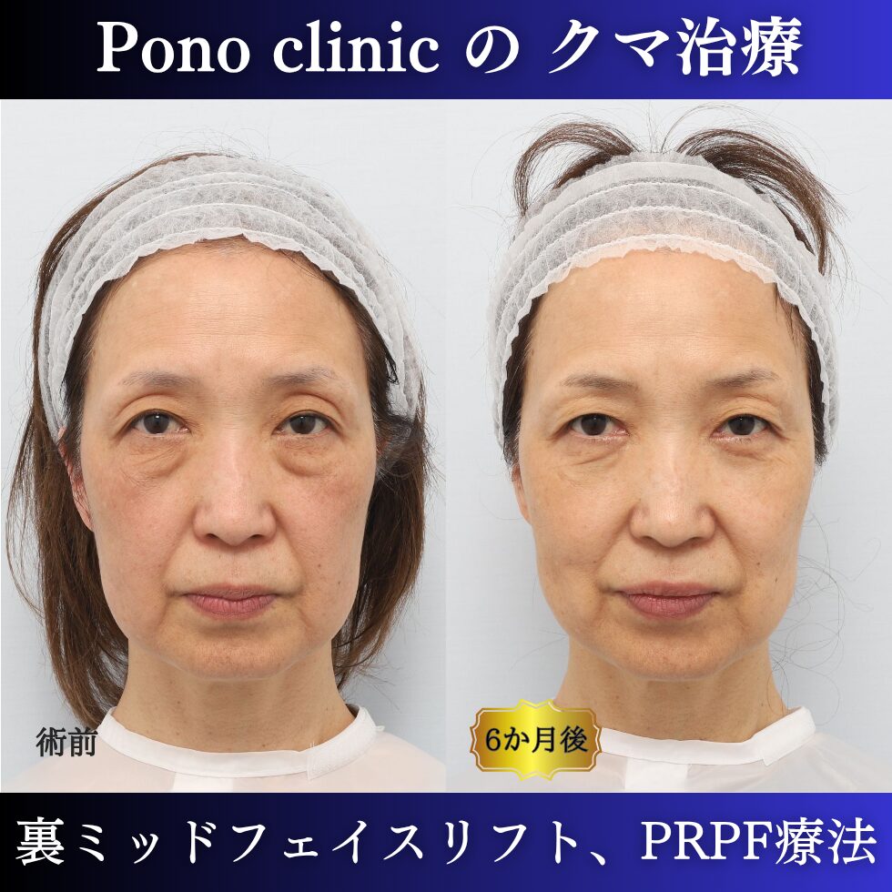 目の下のクマ、目の上のくぼみ、裏ミッドフェイスリフト、PRPF療法、50代の症例 (7)
