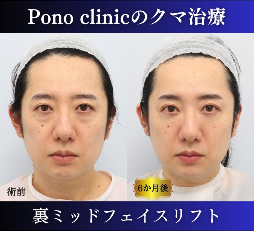 クマ取り東京、裏ハムラ、ミッドフェイスリフトの症例、40代 (5)