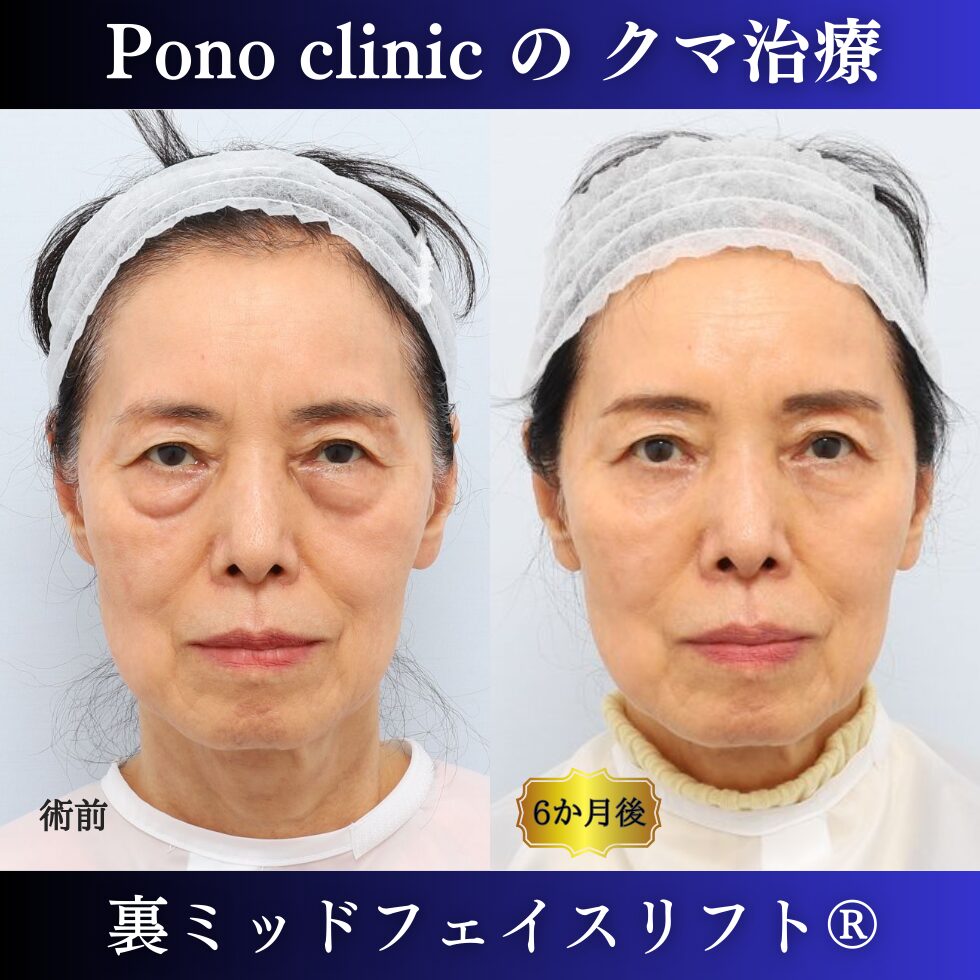 目の下のクマ、目の下のたるみ、クマ治療、裏ミッドフェイスリフト