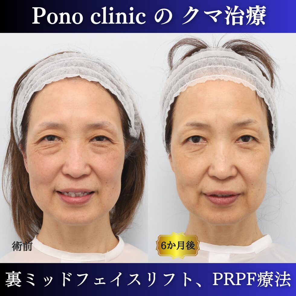 目の下のクマ、目の上のくぼみ、裏ミッドフェイスリフト、PRPF療法、50代の症例 (5)