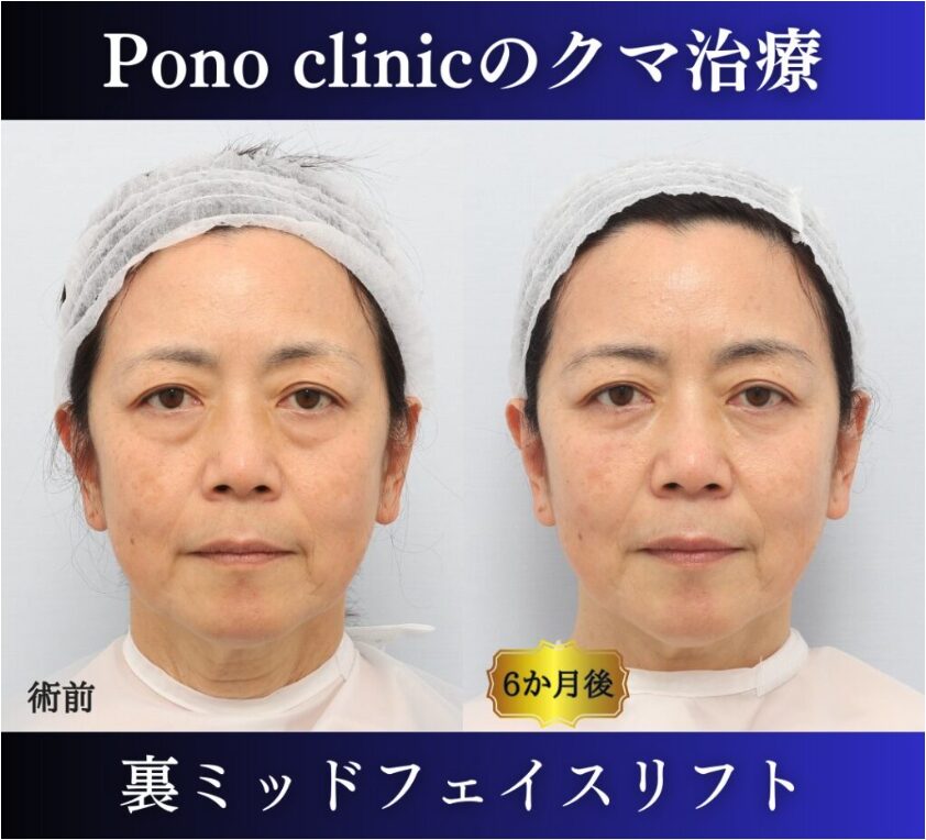 クマ取り東京、裏ハムラ、ミッドフェイスリフト症例、正面