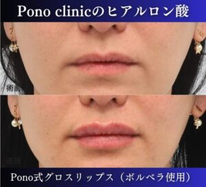 唇ヒアルロン酸注入の症例、直後 (4)