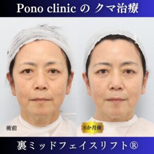 目の下のたるみ、目の下のクマ、60代の症例