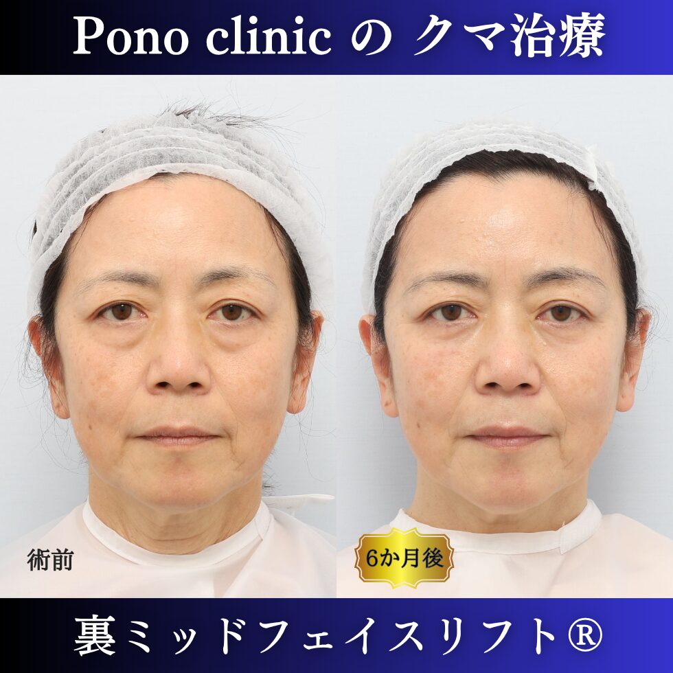 目の下のたるみ、目の下のクマ、60代の症例