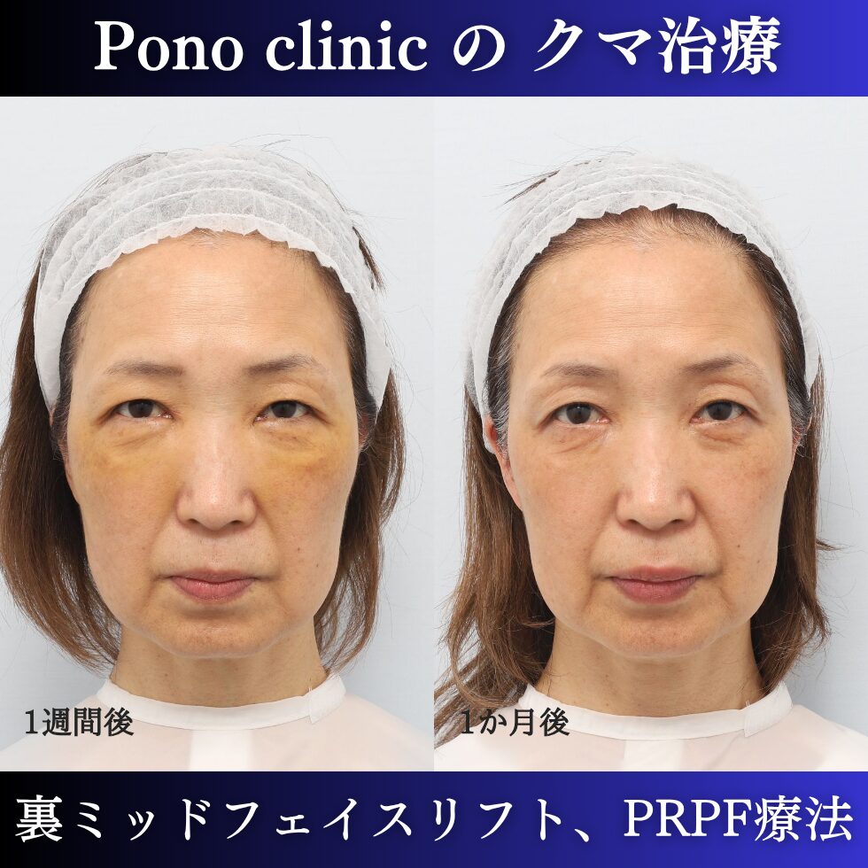 目の下のクマ、目の上のくぼみ、裏ミッドフェイスリフト、PRPF療法、50代の症例 (1)