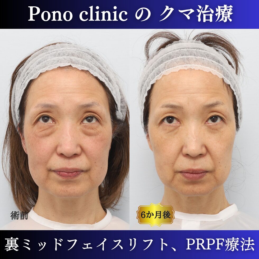 目の下のクマ、目の上のくぼみ、裏ミッドフェイスリフト、PRPF療法、50代の症例 (4)