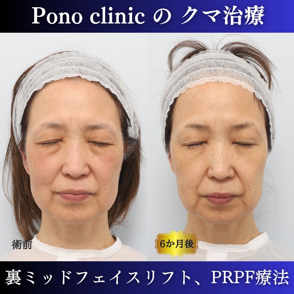 目の下のクマ、目の上のくぼみ、裏ミッドフェイスリフト、PRPF療法、50代の症例 (6)