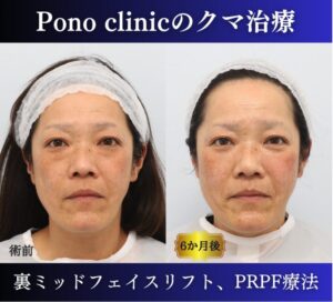 クマ取り東京、裏ハムラ、ミッドフェイスリフト、頬のPRPF療法の症例 (1)