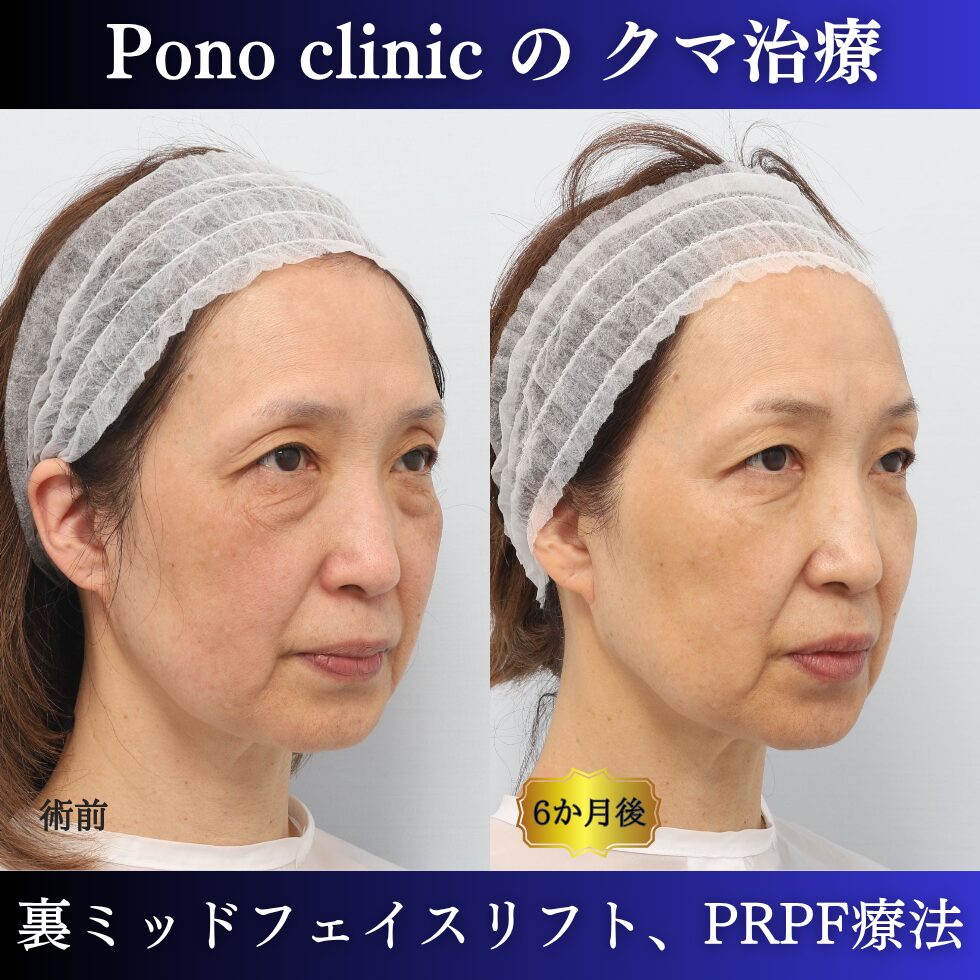 目の下のクマ、目の上のくぼみ、裏ミッドフェイスリフト、PRPF療法、50代の症例 (2)