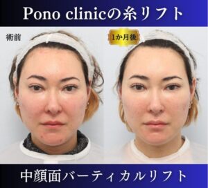 糸リフトの症例、前