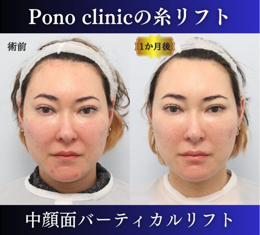 糸リフトの症例、前