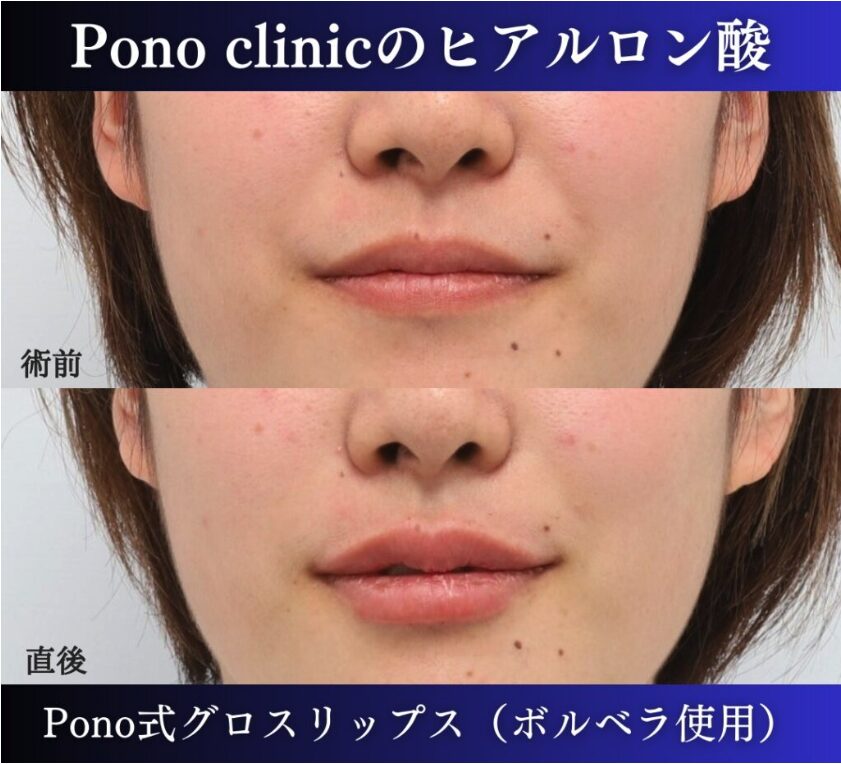 唇ヒアルロン酸注入の症例、直後 (8)